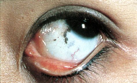 Combined Nevi Of The Conjunctiva Dermatology Jama Ophthalmology Jama Network