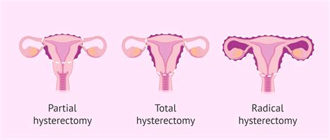 What Is A Hysterectomy
