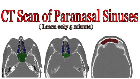 Ct Scan Of Paranasal Sinuses Anatomy Youtube