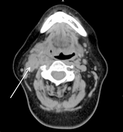 Ct Scan With Enlarged Level Ii Lymph Nodes In The Right Neck Arrow