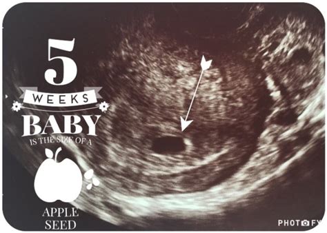 On wednesday i had an early ultrasound scan which was 6 weeks from my last period but when the scan was done all they saw was a gestational sack at 5 weeks 3 days i started bleeding so we went into the hospital and he did a sneaky scan for me. Early Ultrasound (5weeks 5 days) | BabyCenter