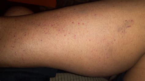 Round Red Spot On Leg Pictures Photos