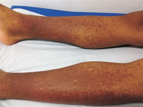 Exercise Induced Vasculitis Pictures Online Degrees