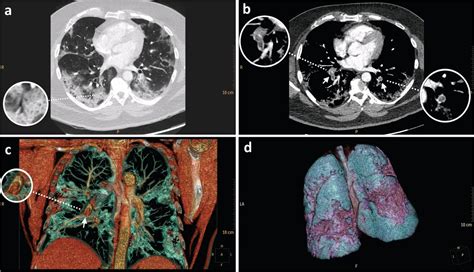 Abrupt Deterioration And Pulmonary Embolism In COVID A Case Report RCP Journals