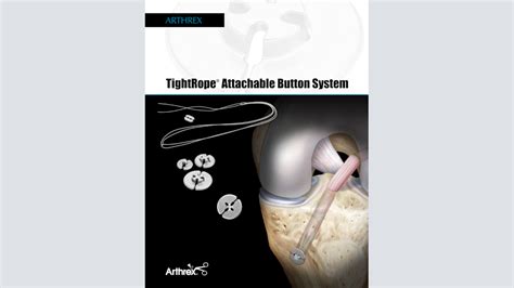 Arthrex Tightrope® Abs Implant And Button