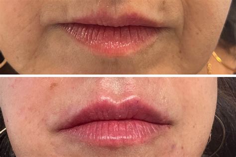 relleno de labios con ácido hialurónico antes y después centro médico estético rusiñol