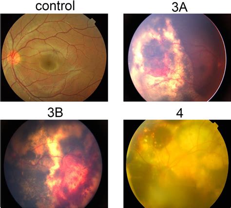 Representative Fundus Views Of The Different Stages Of Coats Disease