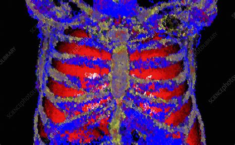 Rib Cage Ct Scan Stock Image C0533169 Science Photo Library