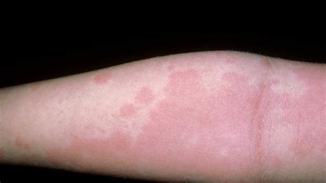 It can occur suddenly, can worsen quickly and can be a second anaphylactic reaction, known as a biphasic reaction, can occur as long as 12 hours. Anaphylaxis Rash : Urticaria Hives Allergy Anaphylaxis ...