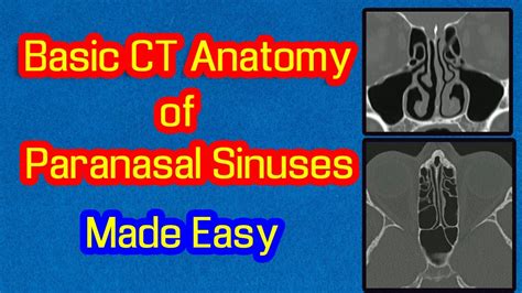 Basic Ct Anatomy Of Paranasal Sinuses Made Easy Youtube