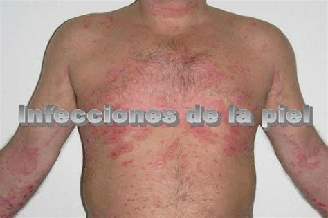 Infecciones De La Piel Clinica Hispana Woodforest