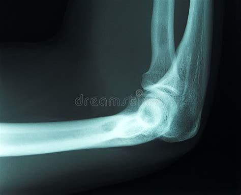 X Ray Of A Male Arm Stock Image Image Of Body Technology 3747517