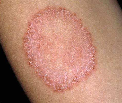 Ringworm Symptoms Signs And Pictures