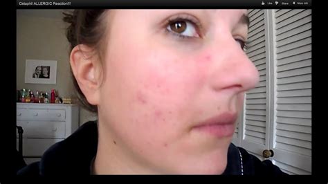 Best baby sunscreens of 2021. Cetaphil ALLERGIC Reaction!!! - YouTube