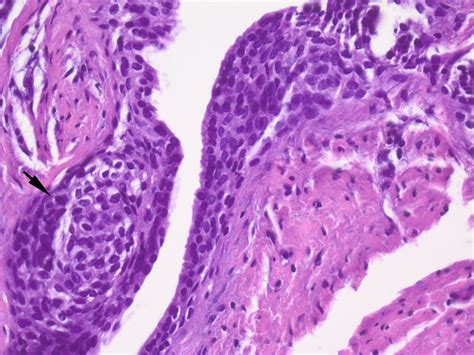 Pathology Outlines Odontogenic Cysts Lateral Periodontal Cyst