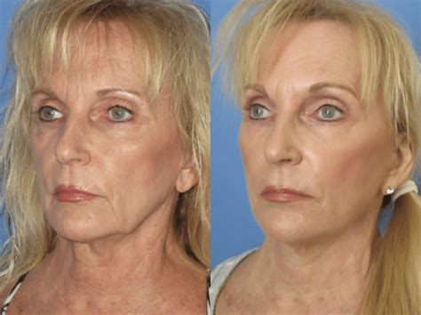 Facelift Tampa 100 5 Star Reviews Elite Facial Plastic Surgery