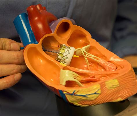A Faster Simpler Heart Valve Surgery Is Gaining Favor The Seattle Times