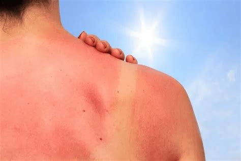 Everything You Need To Know About Sunburn Itching Vinmec