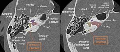 Neuroanatomy Totd 15🧵 The Inner Ear Tweetorial It Packs A Large