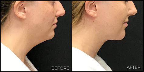 What Is A Short Scar Neck Lift