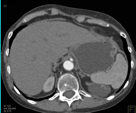 Bosniak Type Ii Cyst Left Kidney Kidney Case Studies Ctisus Ct Scanning