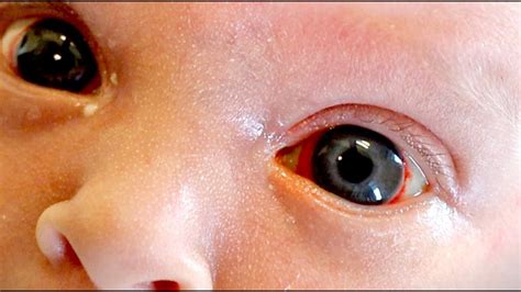 Help My Newborn Has Blood In The White Of His Eyes Subconjunctival