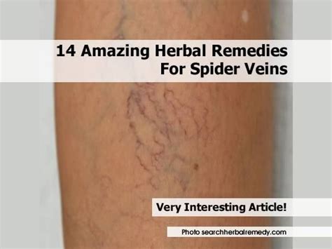 14 Amazing Herbal Remedies For Spider Veins Herbal Remedies Remedies Herbalism