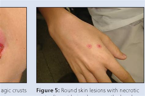 Figure 3 From Management Of Erythema Multiforme Associated With