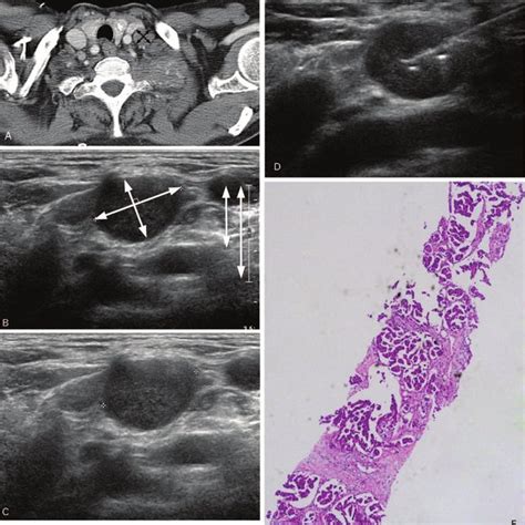Pdf Ultrasonography Guided Core Biopsy Of Supraclavicular Lymph Nodes