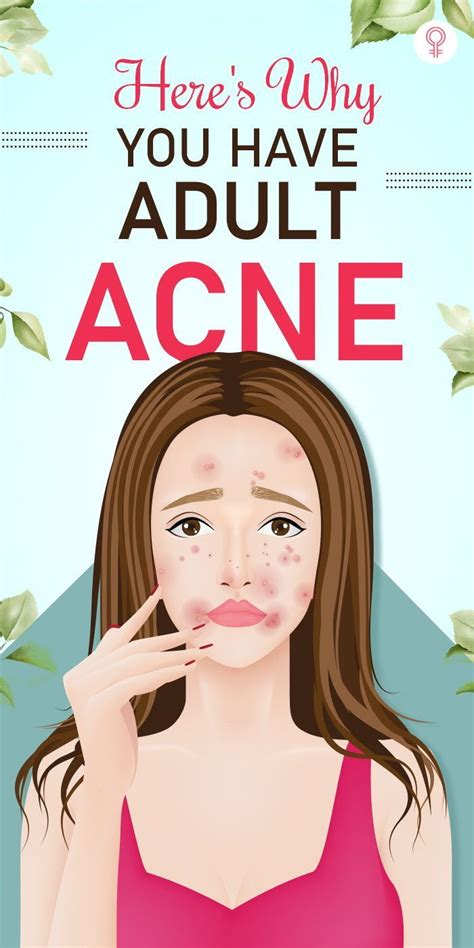 Heres Why You Have Adult Acne With Age Our Skin Starts Getting Dryer Hence You May Need To