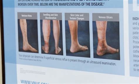 Varicose Veins More Than A Cosmetic Issue Piedmont Healthcare