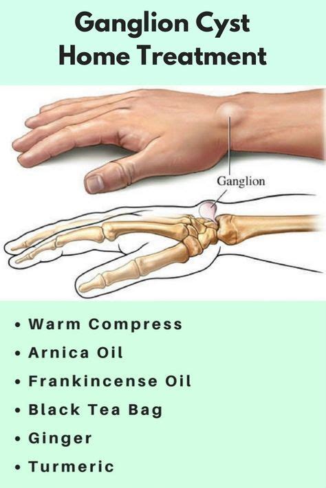 5 Home Remedies To Get Rid Of Ganglion Cysts Youtube Reverasite