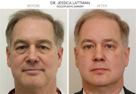 Eyelid Surgery Nyc Cheaper Than Retail Price Buy Clothing Accessories And Lifestyle Products