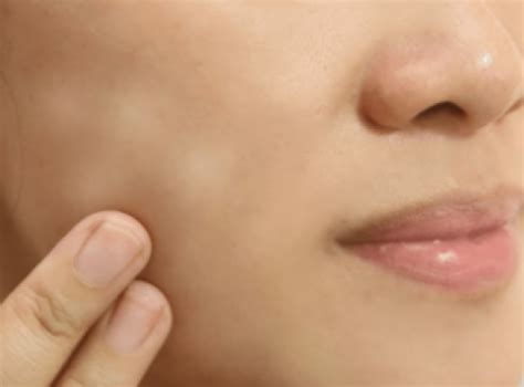White Spots On Kids Face Causes And Remedies Iyurved