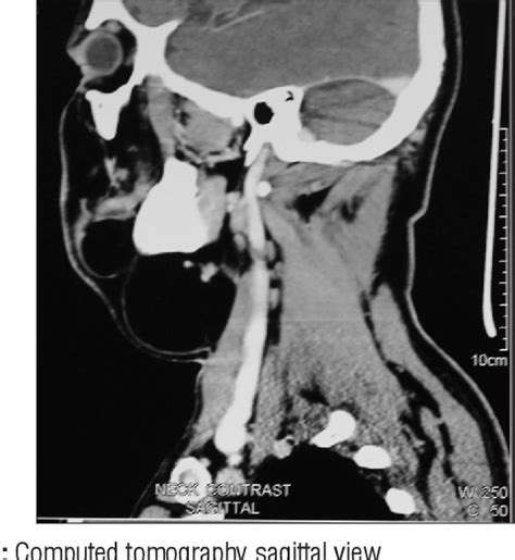 Figure 2 From Giant Multilobular Lipoma Of Neck A Case Report