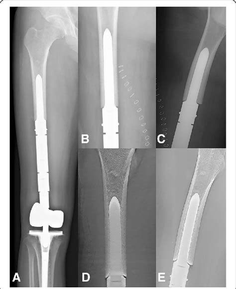 A Case Of Reconstruction Of The Distal Femur Following A Distal