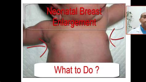 Case What S The Main Cause Of Neonatal Gynecomastia Breast Engorgement Hyperestrogenemia