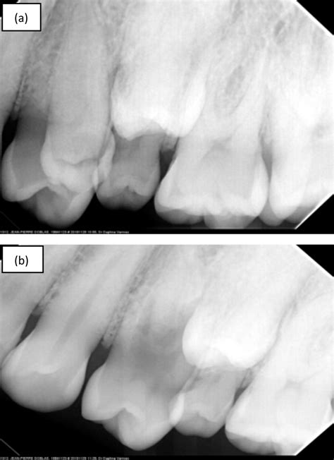 Polydent Multiple Supplemental And Impacted Teeth A Non Syndromic