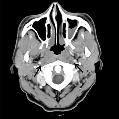 Ct Images Of The Lymph Node Metastases Of Hypopharyngeal Carcinoma A