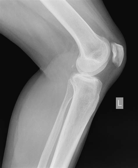 Funny Xray Picture Of Knee