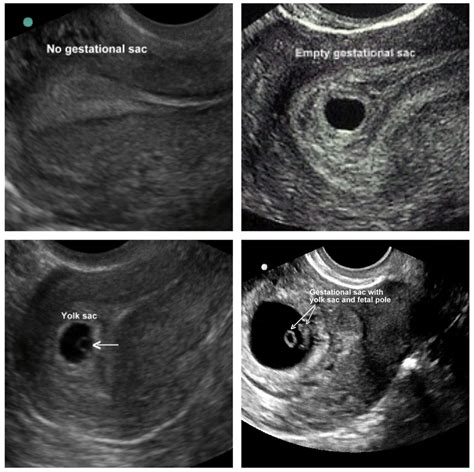 Clinical Concepts In Pelvic Ultrasound — Taming The Sru