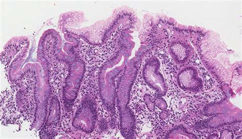 Metaplazia intestinală Dicționar de patologie MyPathologyReport ca
