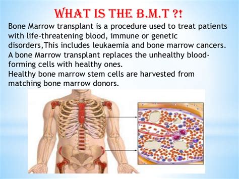 Bone Marrow Transplants