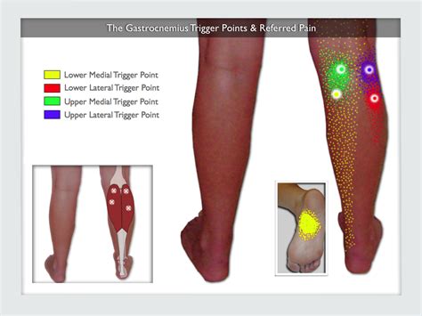 Leg Pain Inner Lower Leg Pain