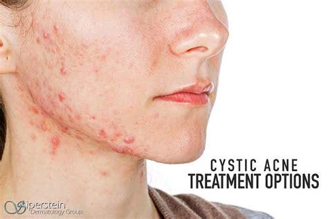 How To Treat Cystic Acne Tips From A Dermatologist Care Beauty