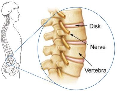 I'm not sure of what you mean by bone diagram. Lower Back Pain Problems - Causes & Treatment