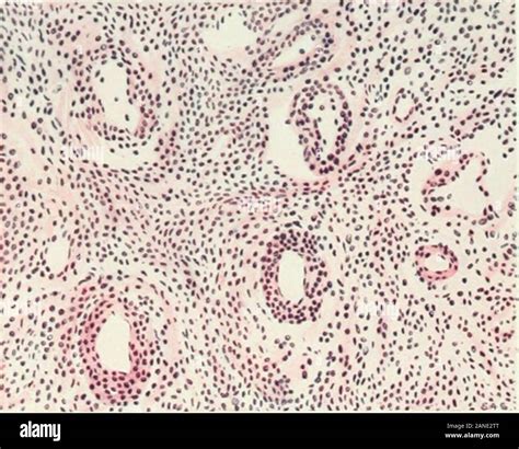 Fibroids And Allied Tumours Myoma And Adenomyoma Their Pathology