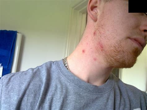 Sore Spots On Jawline Causes And Treatments Justinboey