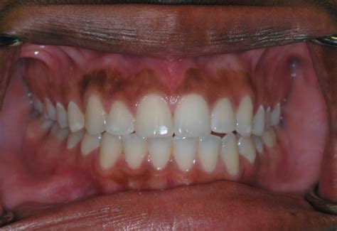 Pigmented Oral Lesions Flashcards Quizlet