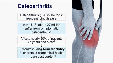 Video My Aching Knees Osteoarthritis Prevention Detection And